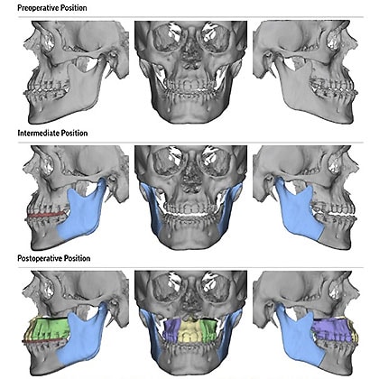 Corrective Jaw Surgery Scarborough Rouge River Oral Surgery